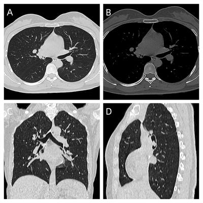 Primary endobronchial multifocal Ewing’s sarcoma: a rare case report
